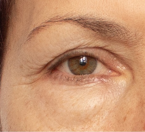 cosmetic surgery in liverpool providing upper blepharoplasty