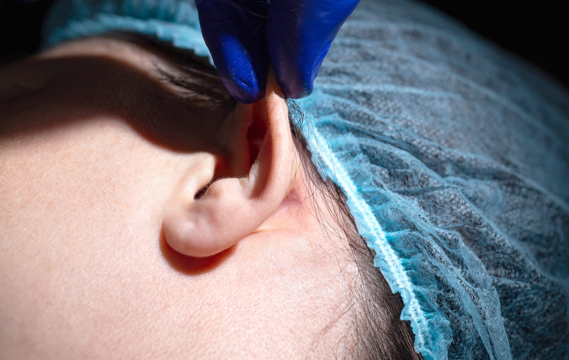 Ear correction surgery in Liverpool EAR PINNING SURGERY