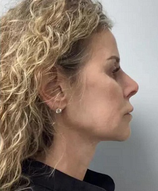 non-invasive facelift