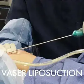 vaser liposuction